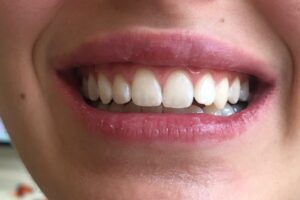 dental fluorosis
